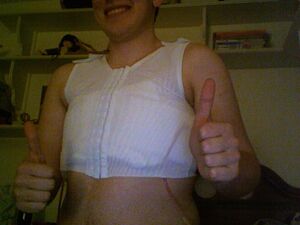 Breast reduction surgery complete